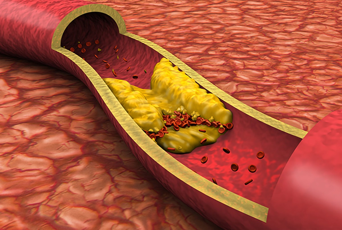 cholesterol